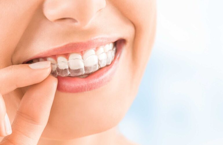 Removable retainers, Invisalign retainers, Essix Retainers at Super Orthodontics In Encino, Los Angeles