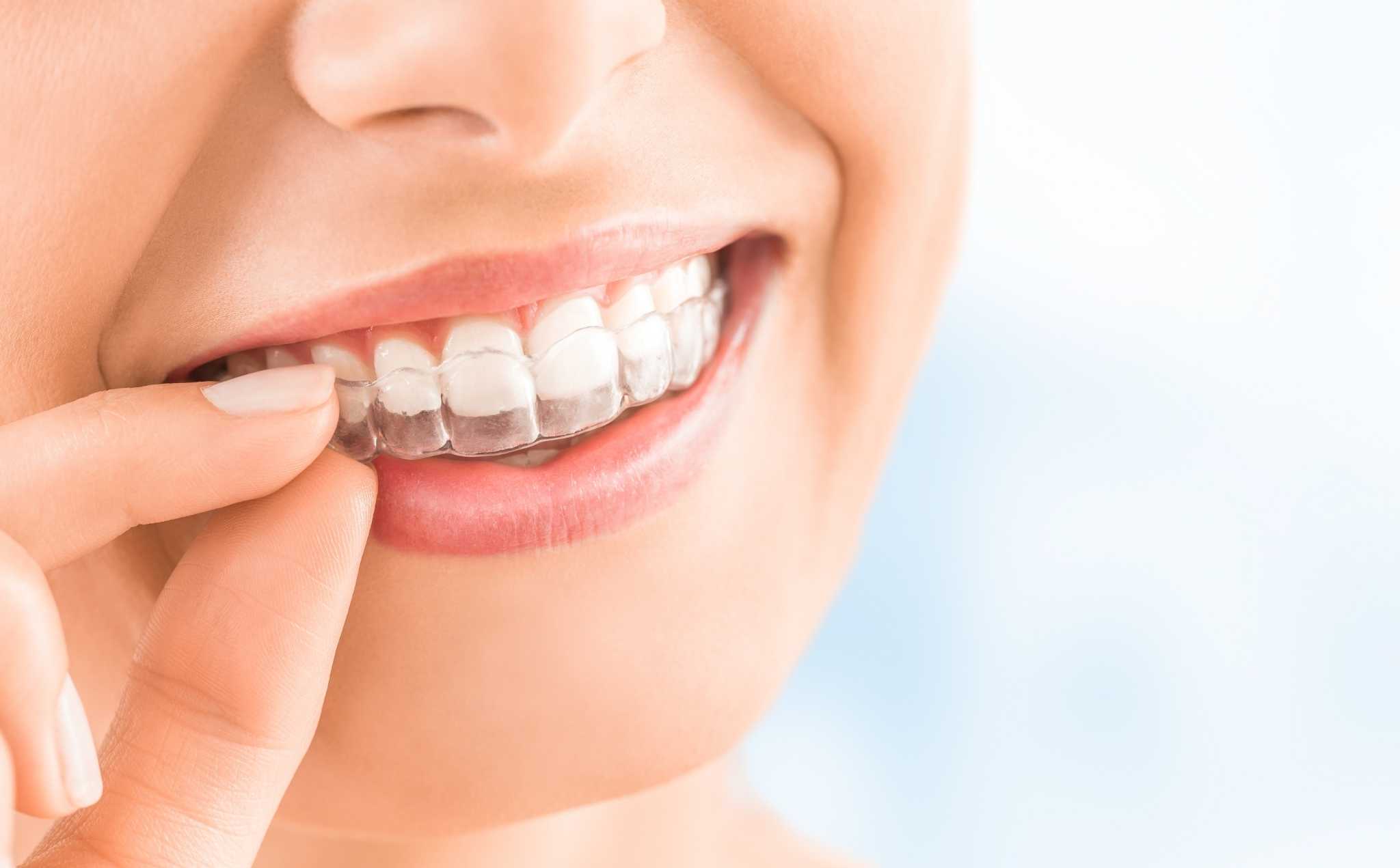 Removable retainers, Invisalign retainers, Essix Retainers at Super Orthodontics In Encino, Los Angeles