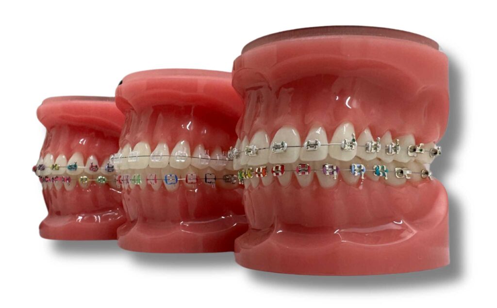 Metal Braces, Ceramic Braces, and different types of Braces offered at Super Orthodontics in Encino, Los Angeles, CA