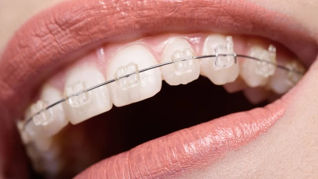 Highest Quality Ceramic Braces offered at Super Orthodontics in Encino, Los Angeles, CA