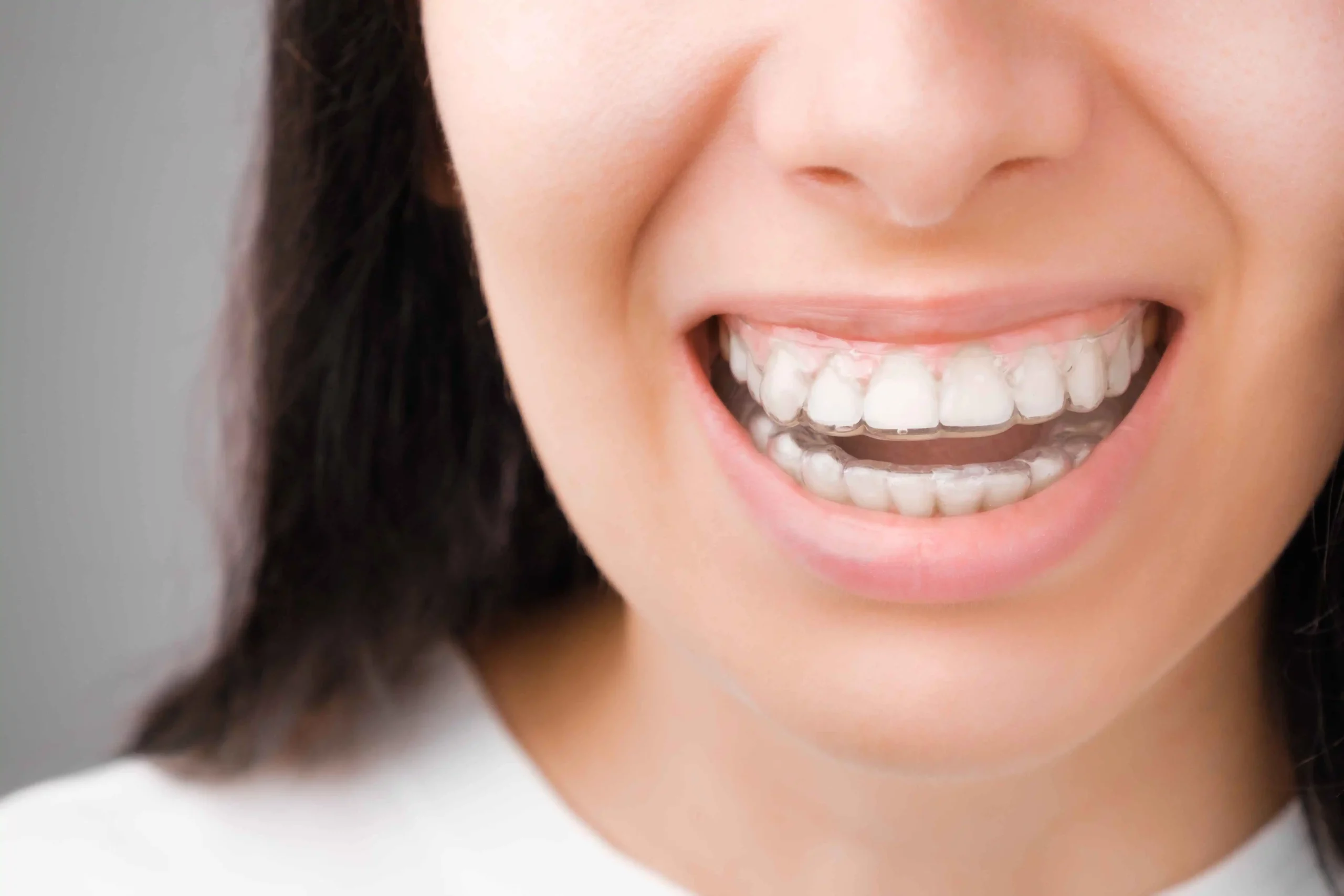 Aesthetic Benefits of Clear Aligners