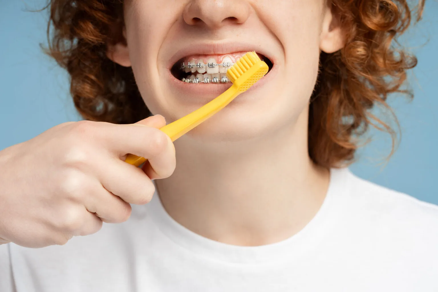 Maintain excellent oral hygiene to keep your braces and teeth healthy.