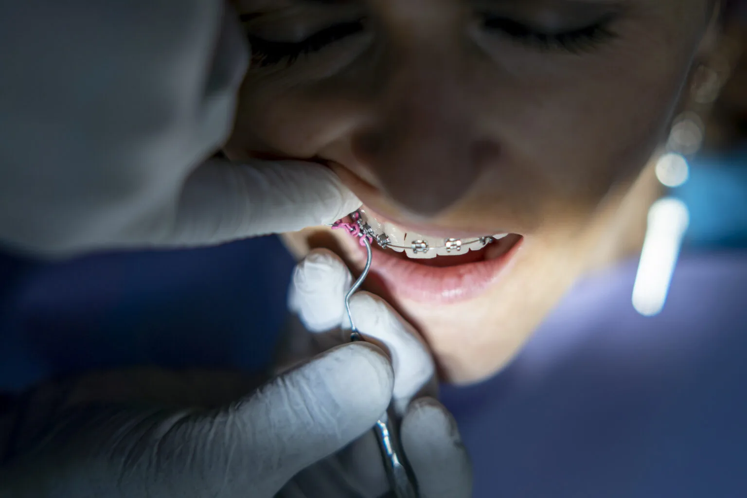 Super Orthodontics ensures optimal braces care, keeping your smile in perfect alignment.