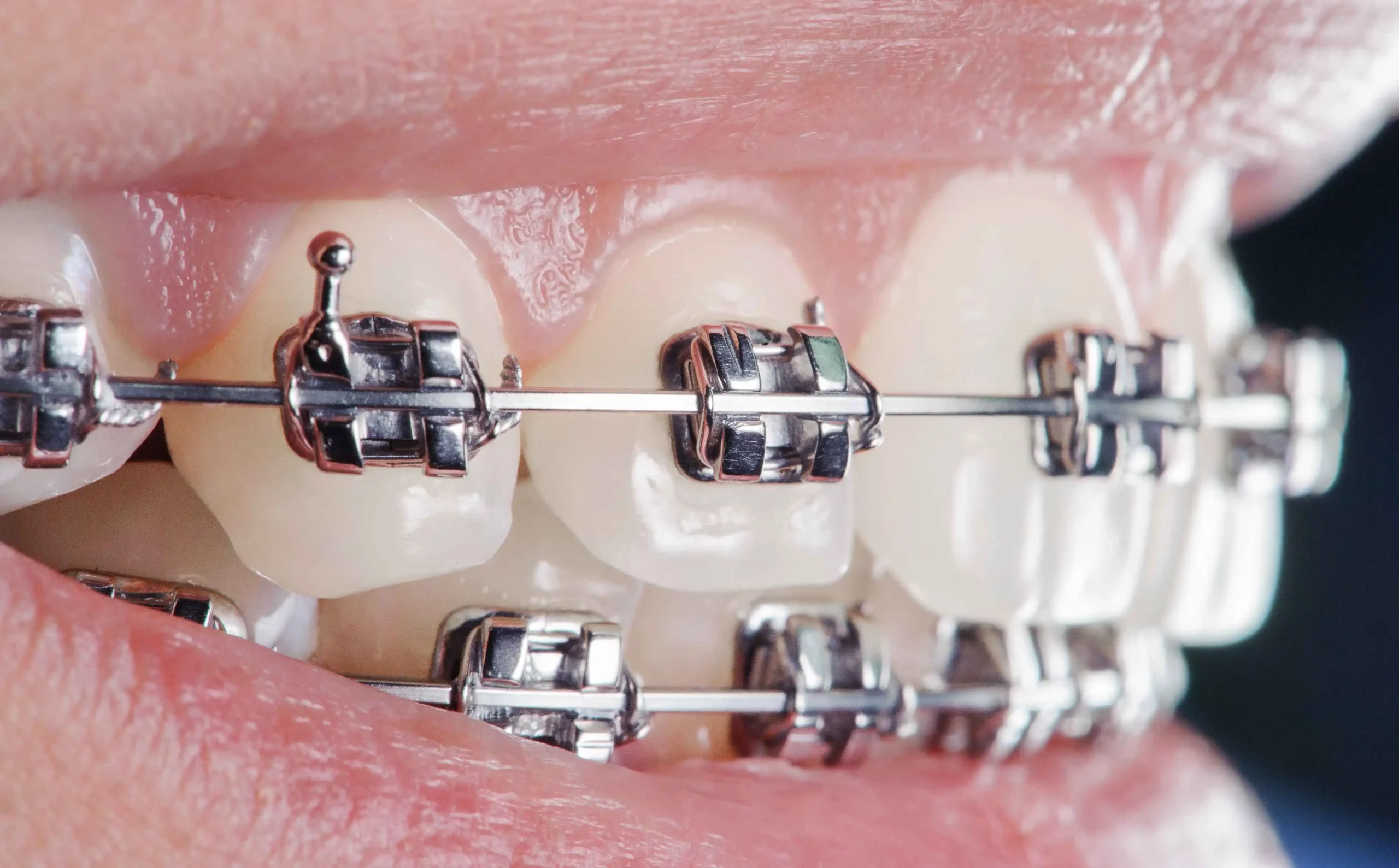 Traditional Metal Braces for adult orthodontics at super Orthodontics