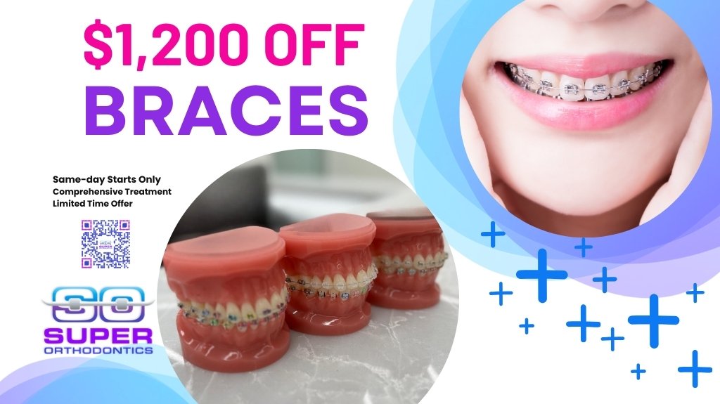 Exceptional Deal On Braces-Super Orthodontics